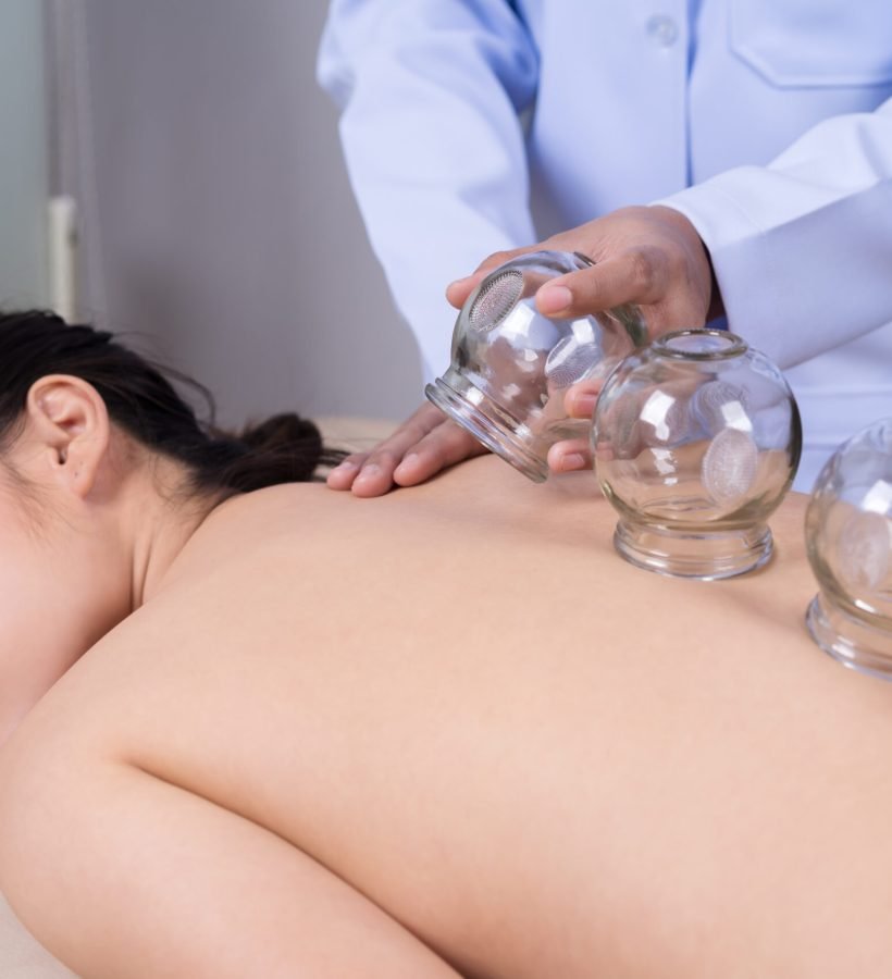 young woman receiving cupping treatment on back